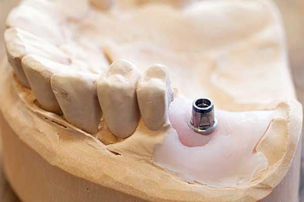 Tandimplantat opereret ind i kæbeknoglen