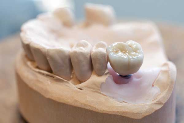 Keramisk tandkrone monteret på implantat