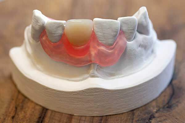 Hvad er en smileprotese